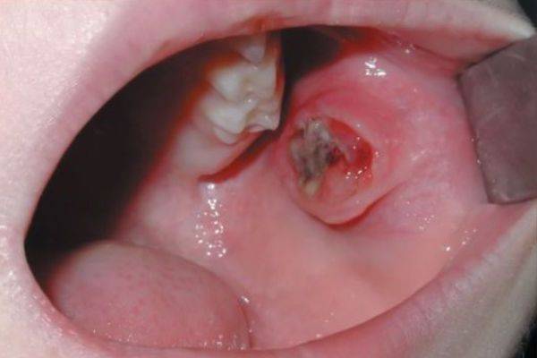 Мокрота с кровью при кашле