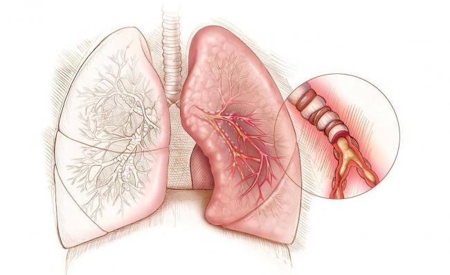 Мокрота с кровью при кашле, причины у взрослых