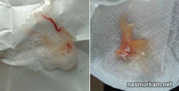 Причины коричневой мокроты