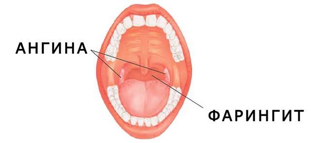 Симптомы отека горла и его лечение