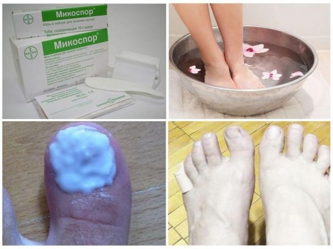 «микоспор» от грибка ногтей: отзывы, цена, инструкция