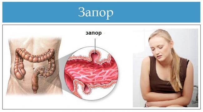 Лучшее слабительное средство от запора