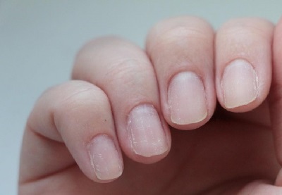 Почему слоятся ногти на руках: причины, лечение в домашних условиях