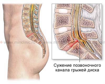 Смещение позвонков поясницы: чем опасно заболевание и как его лечить?