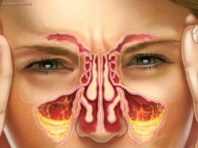 Лечение гайморита