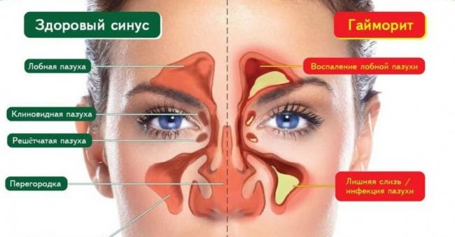 Как избавиться от мокроты и слизи в горле, причины и лечение
