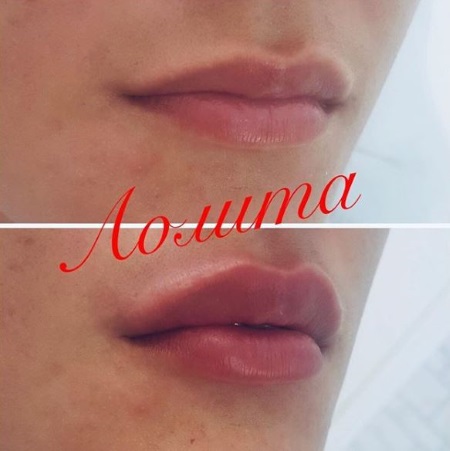 Корилип при беременности