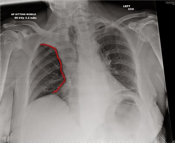 Ателектаз легких: причины, формы, признаки, диагностика, как лечить