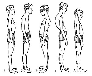 Бочкообразная деформация грудной клетки