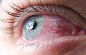 Красные нижние веки у ребенка