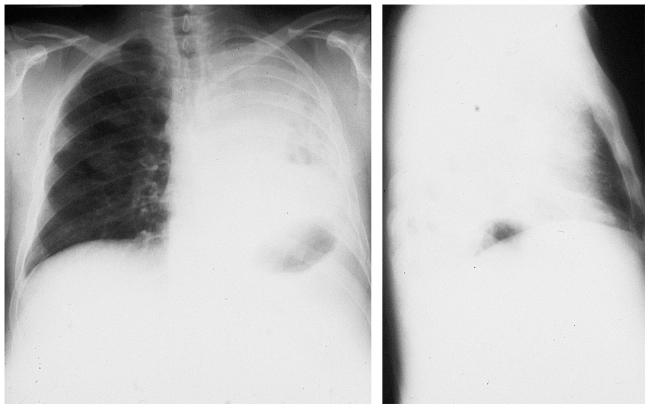 Ателектаз легкого: что это у взрослого, симптомы, лечение, рентген
