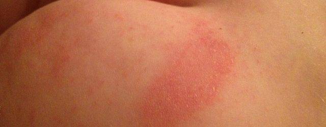 Красная попа вокруг ануса у новорожденного и грудничка