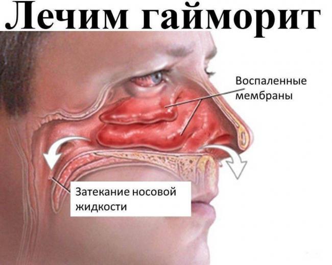 Лечение гайморита без антибиотиков в домашних условиях: эффективные методы