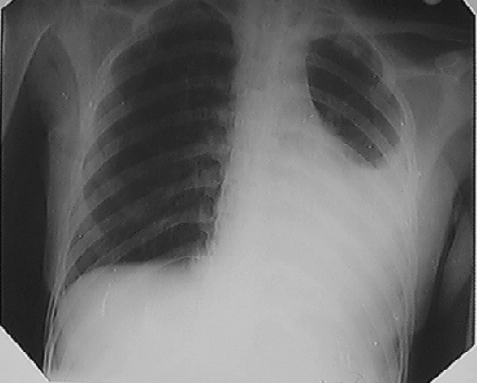 Ателектаз легкого