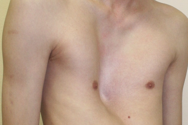 Воронкообразная деформация