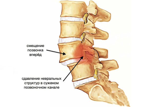 Лечение спондилолистеза шейного отдела позвоночника