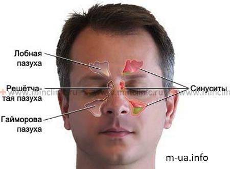Гайморит: симптомы и лечение у взрослых