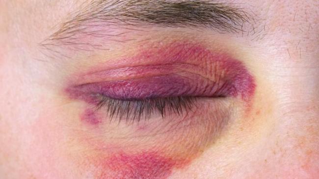 Синяк-офф: гель под глаза, мазь, инструкция по применению