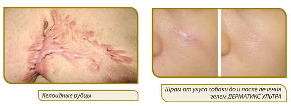 Отзывы на дерматикс гель для коррекции рубцов и способ применения