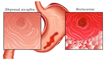 Диета при гастрите с повышенной кислотностью