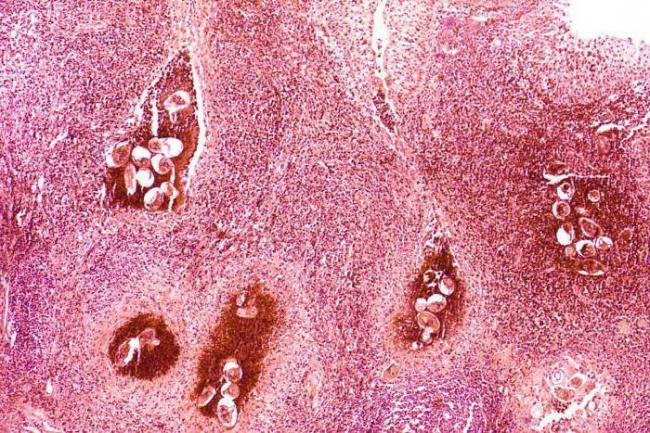 ПИПЕРАЗИН при аскаридах Нужны отзывы ,как принимали