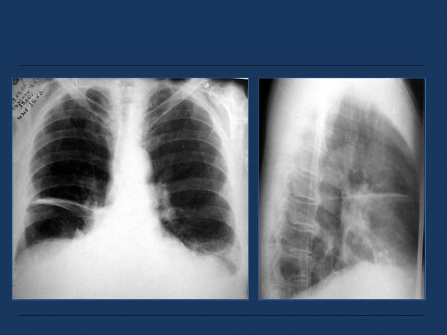Ателектаз легкого