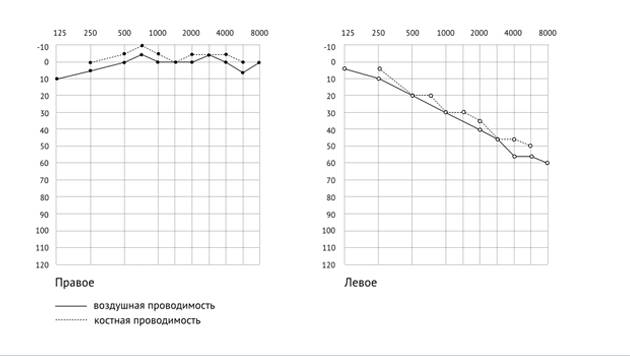 Кохлеарный неврит: причины, симптомы, диагностика и лечение
