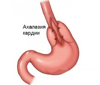 Причины и лечение ахалазии кардии пищевода