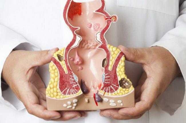 Что нужно знать о геморрое любому человеку?