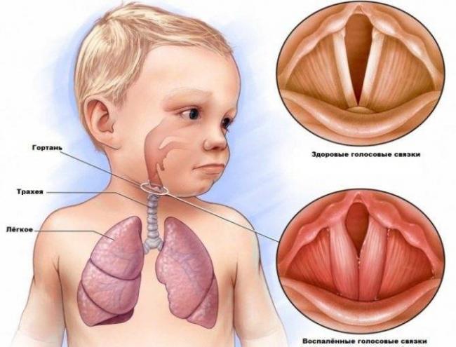 Слизь в носоглотке: как избавиться в домашних условиях, причины и лечение