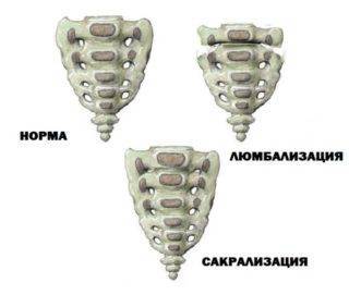 Что делать, когда болит крестец? причины боли в области крестца