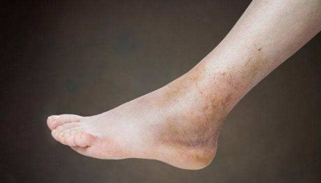 Мазь для наружного применения Акрихин Акридерм - отзывы