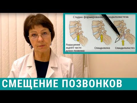 Спондилолистез шейного и пояснично-крестцового отдела позвоночника: что это, лечение