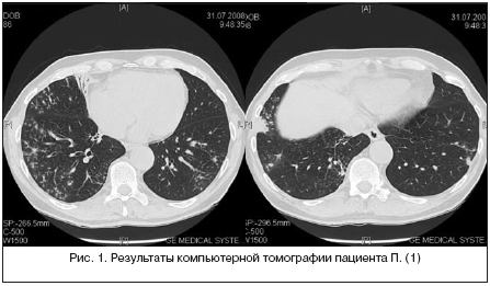 Уточнение диагноза по кт грудной клетки?
