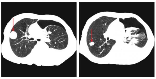 Почему возникают и чем опасны очаги в легких