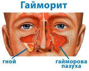 Лечение гайморита народными средствами: самые эффективные рецепты