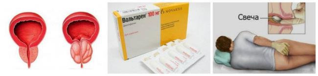 Вольтарен Эмульгель