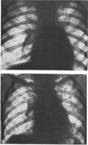 Пневмосклероз легких – что это такое? очаговый, диффузный пневмосклероз – лечение, продолжительность жизни