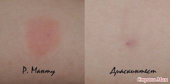 Не знаете, какой результат надежнее - манту или диаскинтеста? сделайте оба одновременно