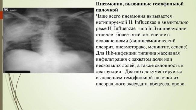 Пневмонит: отличие от пневмонии, причины, симптомы, принципы лечения