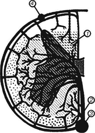 Застойная пневмония у лежачих больных: лечение, симптомы, профилактика