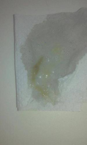 Мокрота с кровью при кашле, причины у взрослых