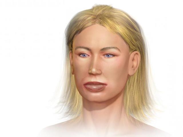 Ангионевротический отек гортани