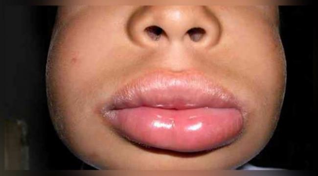 Отек квинке: неотложная помощь, симптомы и лечение