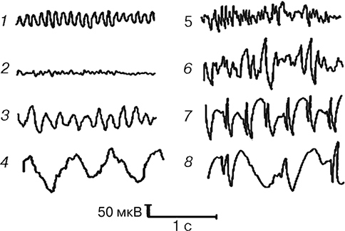 Почему развивается воспаление легких у лежачих пожилых людей?