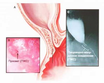 Ахалазия кардии — википедия с видео // wiki 2