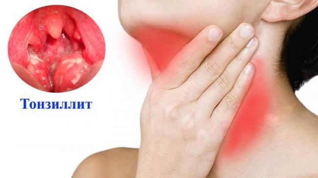 Закаливание горла при хроническом тонзиллите