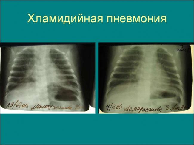 Пневмония у недоношенных детей: сколько лечиться новорожденным, внутриутробная форма
