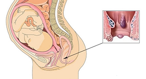 Геморрой и рак: как отличить на ранних стадиях патологии?