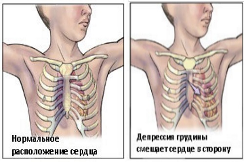 Причины деформации позвоночника и грудной клетки